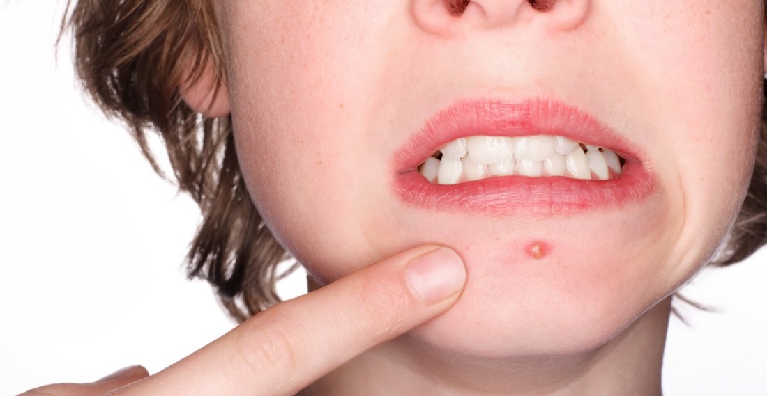 acne-brufoli-brufolo